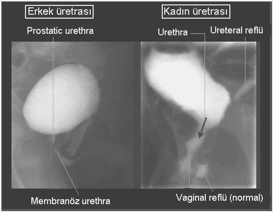 19: Retrograd sistogram a) A-P, b) sol oblik c) sağ oblik Miksiyon Sistoüretrografide (Voiding Sistoüretrografi)Anatomik