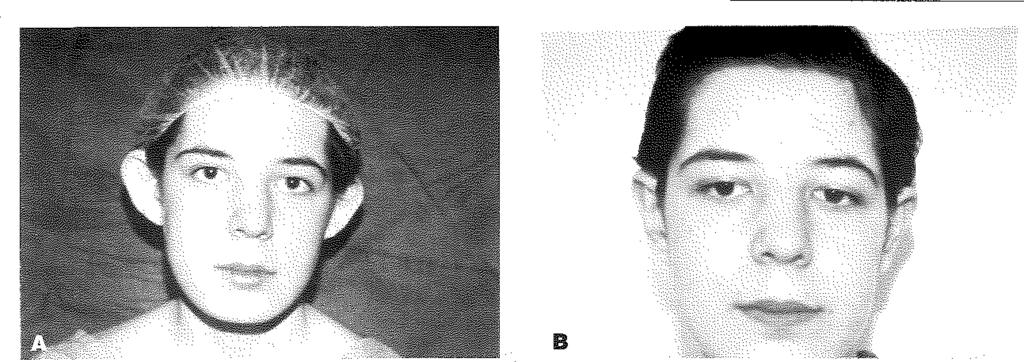 Preoperatif görünüm, sol kulak D. Postoperatif görünüm, sağ kulak F.