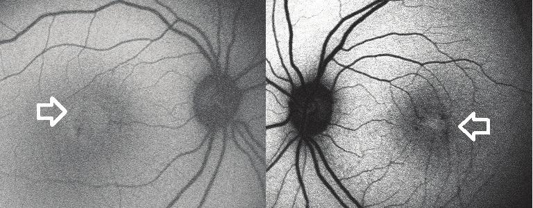 retinal katlarda kistik değişiklik mevcuttu (Resim 2).