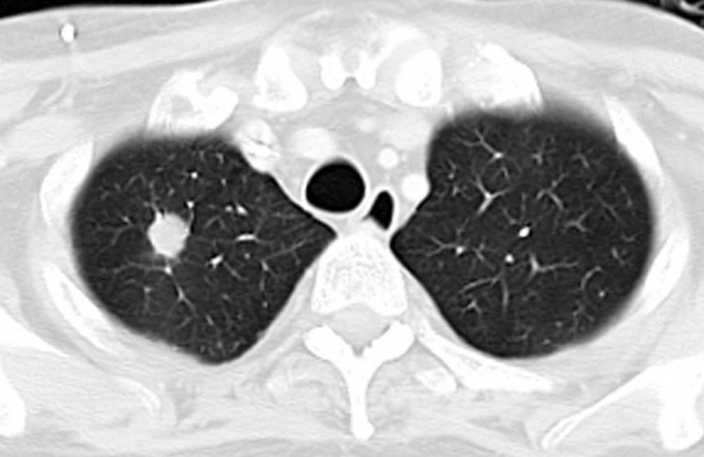BT pulmoner - Fungal anjiyografi enfeksiyonlar Duyarlılık - Bakteriyel %83, özgüllük