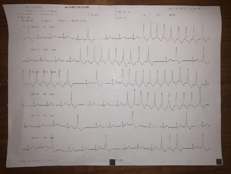 EKG (şikayeti