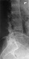 KAS- İSKELET: Omurganın Osteoporozu Özellikle uzun süredir hasta olanlarda sıktır.