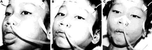 Paralysis 3) Hemorrhagic syndrome: Low platelet