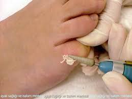 5. Ön ülseratif belirtilerin tedavisi Diyabetli bir hastada ayağı üzerinde herhangi bir ön ülser belirtisi tedavi edilir.