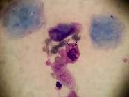 OLGU Hastanın nodüler lezyonundan Tzanck yayma yapılıp ve May-Grünwald Giemsa boyası ile boyanıyor Mikroskobik incelemede: Nekrotik keratinositler, nötrofiller ve bazı keratinositler