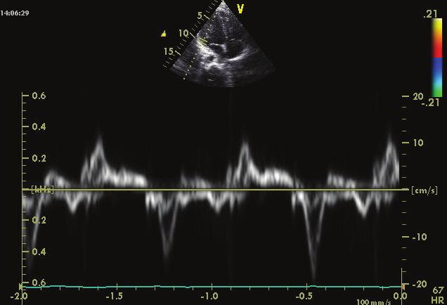 S dm A dm E dm Şekil 8: Pulsed dalga doku doppler ekokardiyografi ile Sol ventrikül bazalde elde edilen miyokardiyal hız örneği (S dm :Mitral sistolik dalga, E dm :Mitral erken diyastolik dalga, A dm