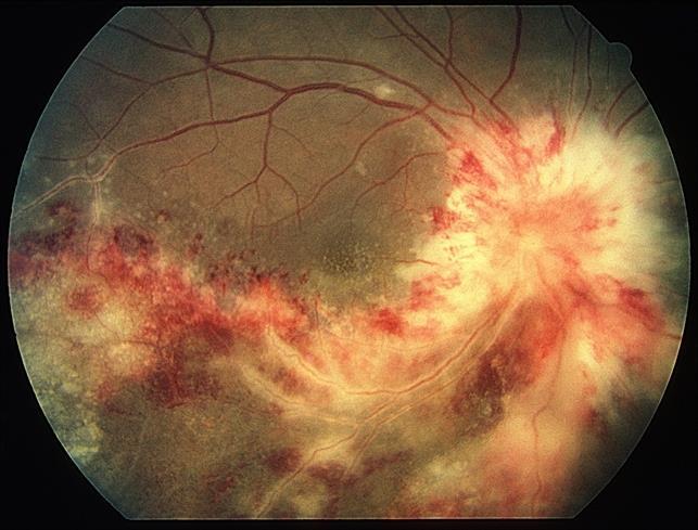 retinal lezyonlar