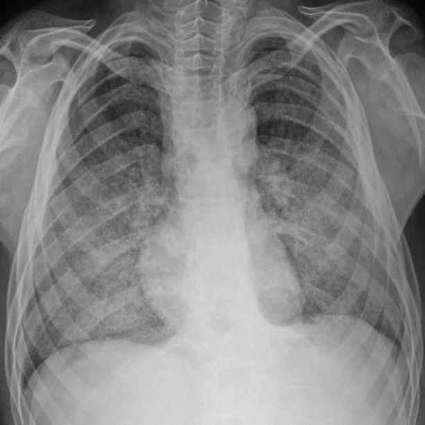 GİRİŞ 63 Erişkinin akut respiratuar distres sendromu (ARDS) son 1 hafta içinde yeni gelişen ya da kötüleşen akciğer semptomları, akciğerlerde plevra sıvı, atelektazi ya da nodül ile açıklanamayan,