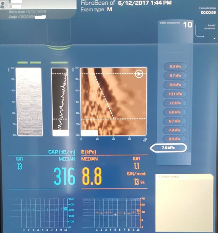 Fibroscan