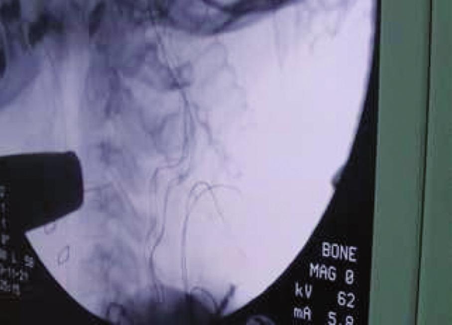 1-3 Spinal araknoid kistlerin oluşum mekanizması net değildir.