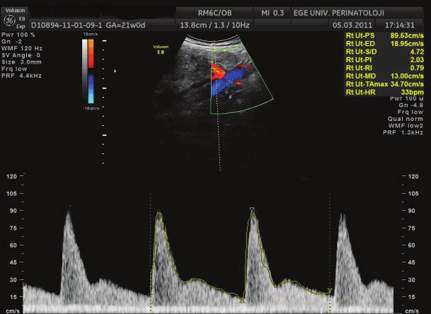 (B) Artmış plasental vasküler direnç ve erken diyastolik çentik Umblikal arter: Klinik pratikte en fazla çalışılan damar lokalizasyonudur. Doppler ile görüntülenmesi oldukça basittir.