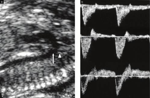 A B Resim 5 : (A) Longitudinal aortik ark planında aortik istmus segmenti görünümü (ince uzun ok), sol subklavian arterin orijini (kalın kısa ok).