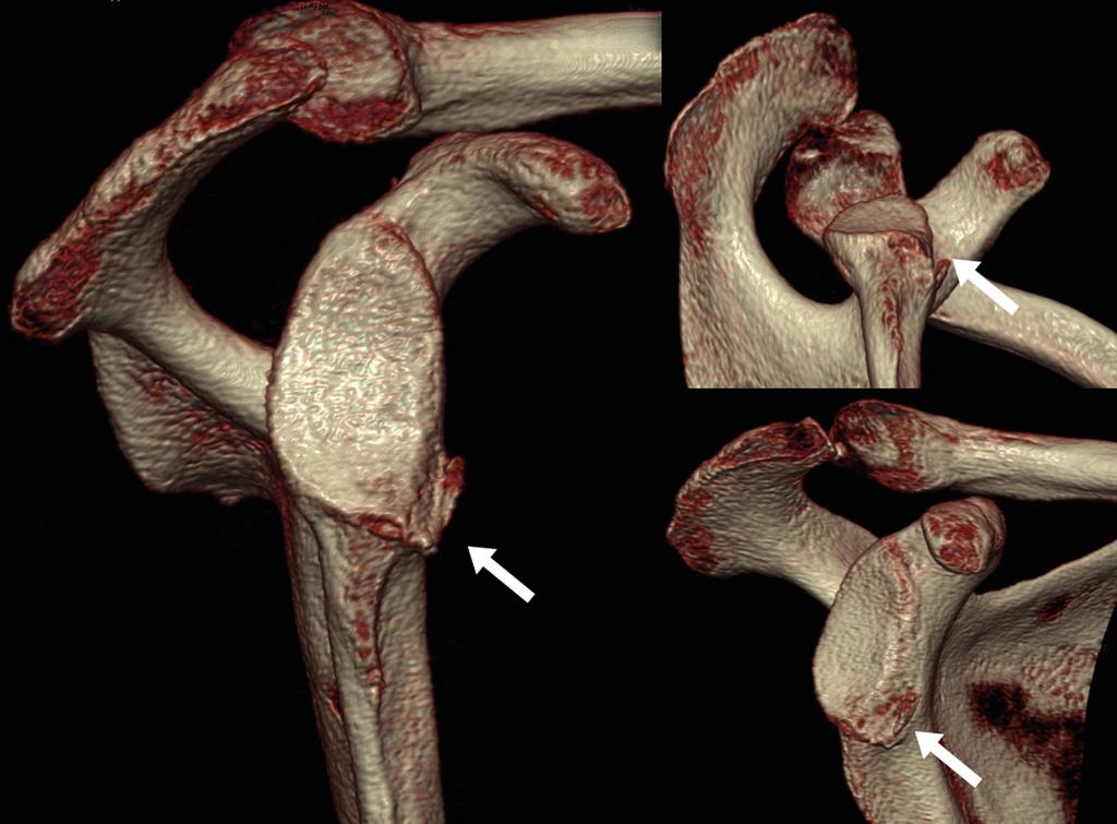 Anterior instabilite: Yineleyen çıkık ve revizyon cerrahisi 315 Şekil 1. Glenoid anteroinferior osseöz lezyonu, 3 boyut rekonstrüksiyonlu bilgisayarlı tomografi ile değerlendirilebilir (beyaz ok).