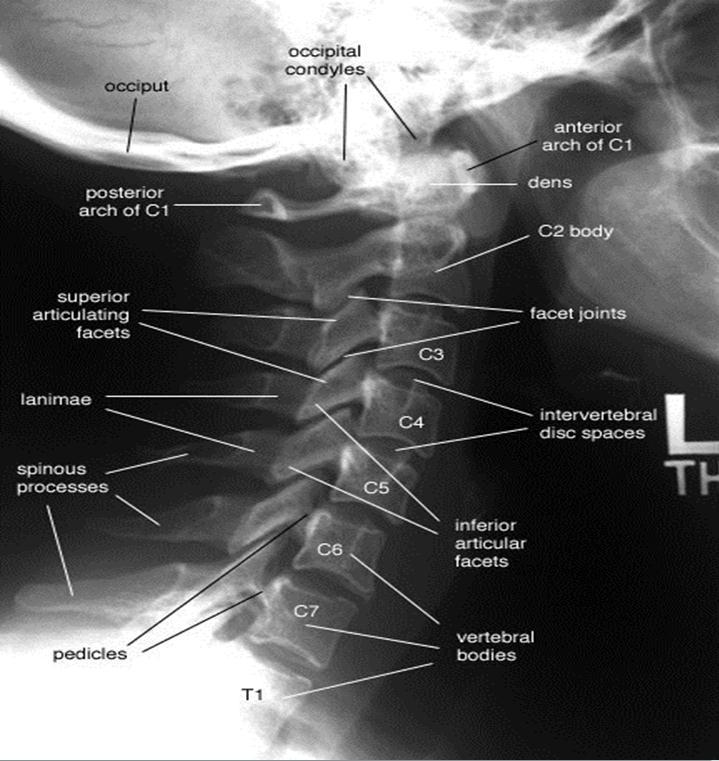 C3-C7 Anterior spinal, posterior spinal ve spinolaminar hatlar: düz olmalı Disk aralıkları: yaklaşık aynı olmalı Anteriorda daralma: fleksiyon