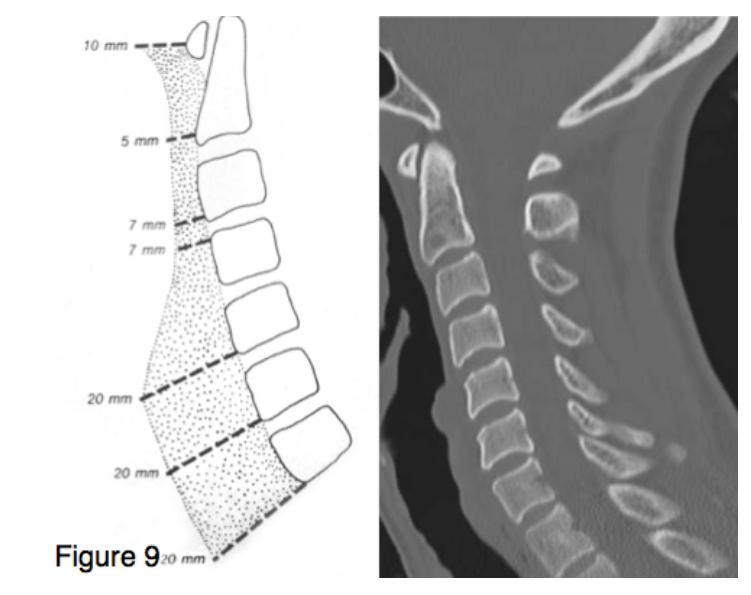 Midline Sagittal Görüntü C2 5mm veya C5 15 mm prevertebral yumuşak doku kalınlığı Dens-basion distance <9.