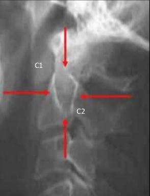 fragmanlarının anteroposterior yer değiştirmesi C2 fat