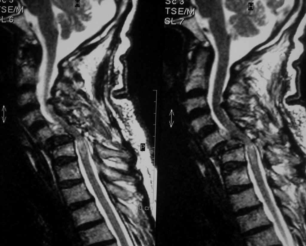 MRI Spinal kord ödem, hemoraji, kord kesisi Paravertebral yumuşak doku Travmatik disk
