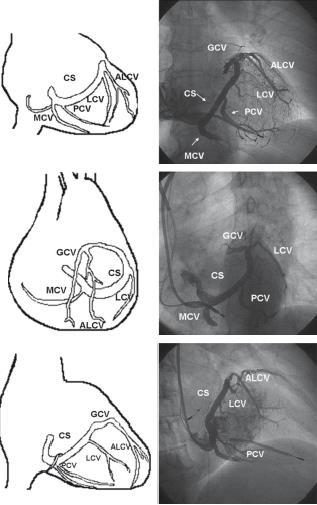 venografik görüntüleri (sağda) ve aynı pozisyonlardaki anatomik şemaları (solda) izlenmektedir.