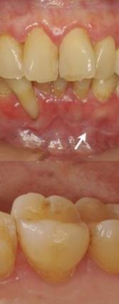Diş kliniğine başvuru (2017): Üst alt diş eti ve yanak mukozasında; beyaz
