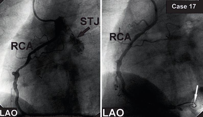 Figure 4: The high takeoff of the right coronary artery is seen. The right coronary artery shows significant atherosclerotic involvement and coronary artery aneurysm.