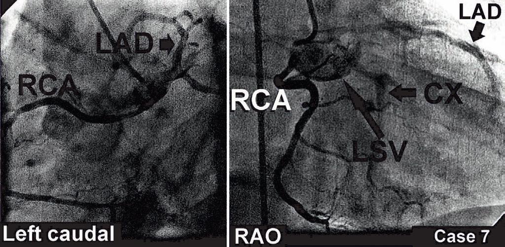 Figure 5: It is seen the retroaortic course of the anomalous right coronary artery originating the left sinus (CX: Circumflex coronary artery, LAD: Left anterior descending artery, LMCA: