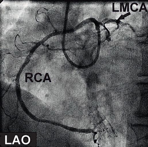 Figure 2: The anomalous right coronary artery arises from the left sinus with acute angulation (LAO: Left anterior oblique, LMCA: Left main coronary