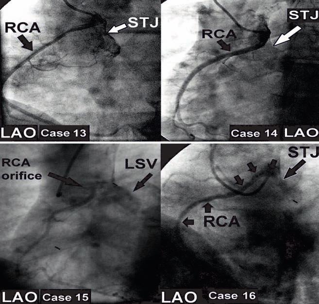 Acute angulation of the right coronary artery is angiographically seen in cases 13 and 16 only (LAO: Left anterior oblique, LSV: Left sinus of Valsalva,
