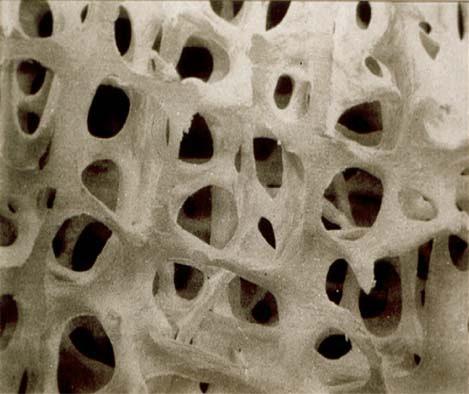 Normal kemik Osteoporotik kemik Şekil 5: Normal ve Osteoporotik Kemik Doruk kemik kütlesinin gelişiminde, genetik ve çeşitli çevresel faktörlerin önemli etkileri vardır.