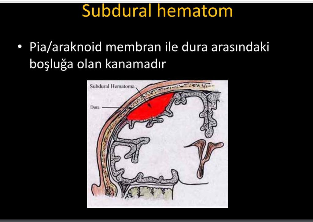 Dura ile araknoid