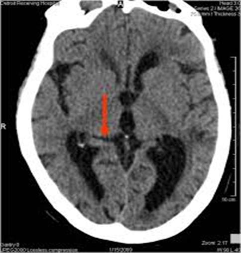 Bilgisayarlı Tomografi (BT): Kontrastsız inceleme akut inme olgularında ilk tanı