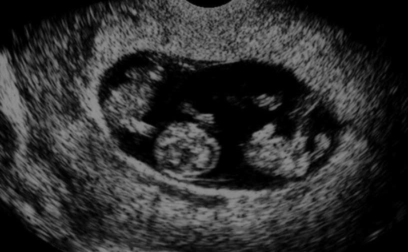 Embryo redüksiyonu Abortus 4-5 % Prematur