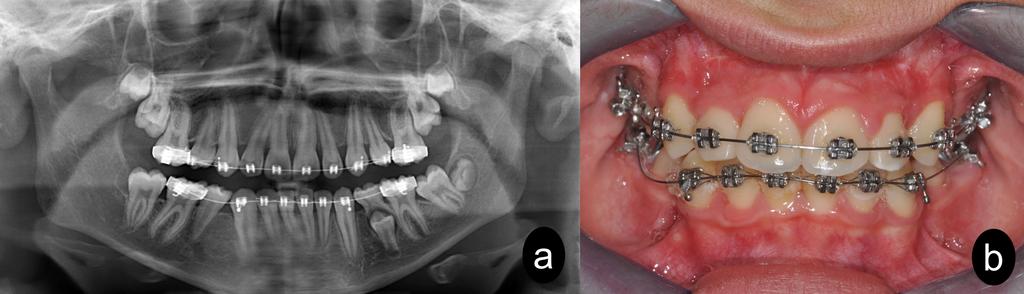İLHAN KAYA-MUHAMMED ÇAĞRI ŞİBAL 96 Resim 3: Hastanın operasyon sonrası 6. aydaki panoramik radyografik görüntüsü (a) ve ağız içi görüntüsü (b).