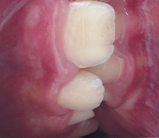 Kök gelişimini tamamlamamış dişlerde dişin kendiliğinden sürmesi beklenirken 3 hafta içinde hiç hareket gerçekleşmezse ortodontik kuvvet ile dişin ekstrüze edilmesi amaçlanır (4).