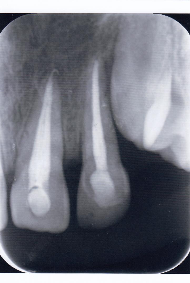 Daimi üst sol maksiller santral diş komşu santral dişe göre daha ekstrüze konumlandığı için bu dişte mine düzeyinde hafif bir