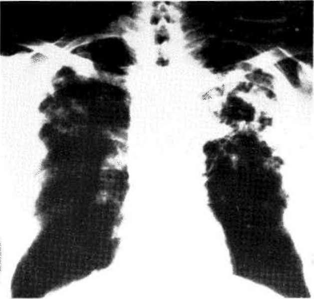 Fîbroprodüktif tüberküloz Inaktif olarak belirtilmemelidir (Şekil 2). Eğer radyografide 6 ay boyunca değişiklik saptanmamışsa, radyolojik olarak stabil olduğu söylenebilir (2).