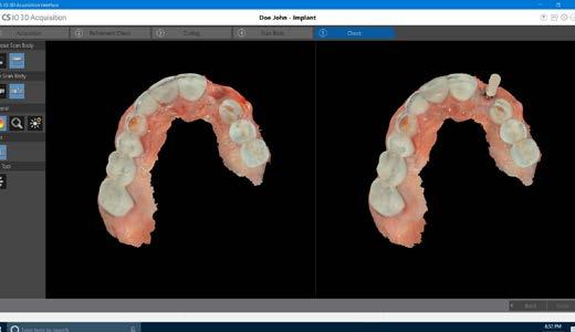 beyaz Dijital çalışma modellerinin oluşturulması, ortodonti uygulamaları ve sabitleyiciler için gerekli olan full palatal çift çene taramasını hızlı ve kolay bir biçimde elde edin.