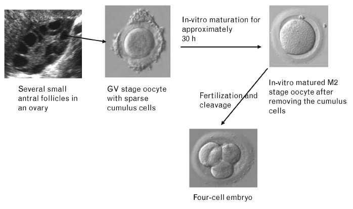 İn vitro Maturasyon(IVM) Antral foliküllerden GV oositlerin elde