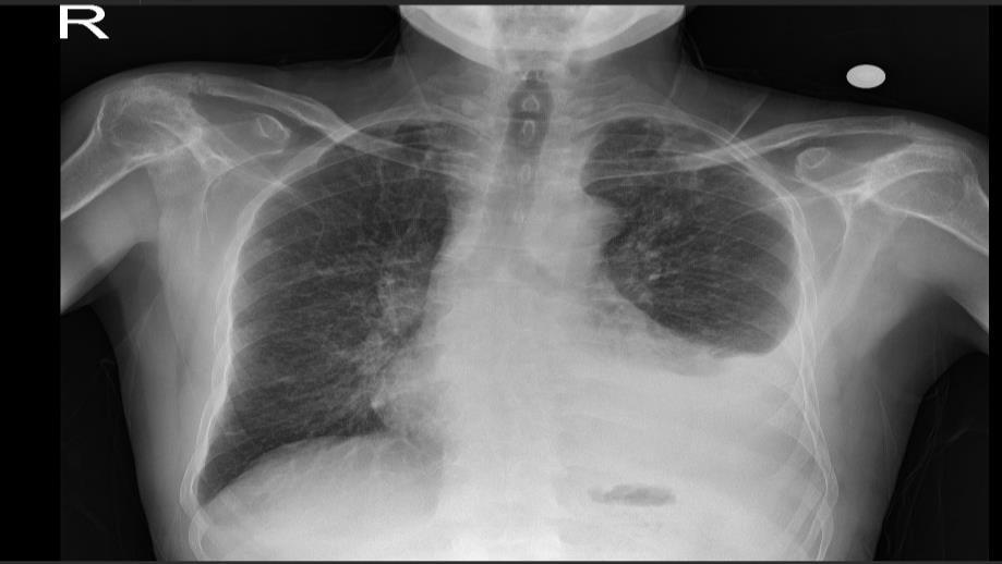 02 04 Mart 2019, Uludağ TNFi öncesi tarama: Laboratuvar (hemogram, KCFT, GFR, glu, lipid) HBV, HCV, HIV (risk faktörü varsa) PAAC PPD Enfeksiyon dışla Malignite dışla KKY dışla (NYHA sınıf III/IV ve