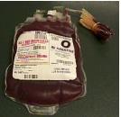 Perkütan Bulaş ve Kan Transfüzyonu Tarama testlerinden önce büyük bir sorundu Tarama testlerine rağmen