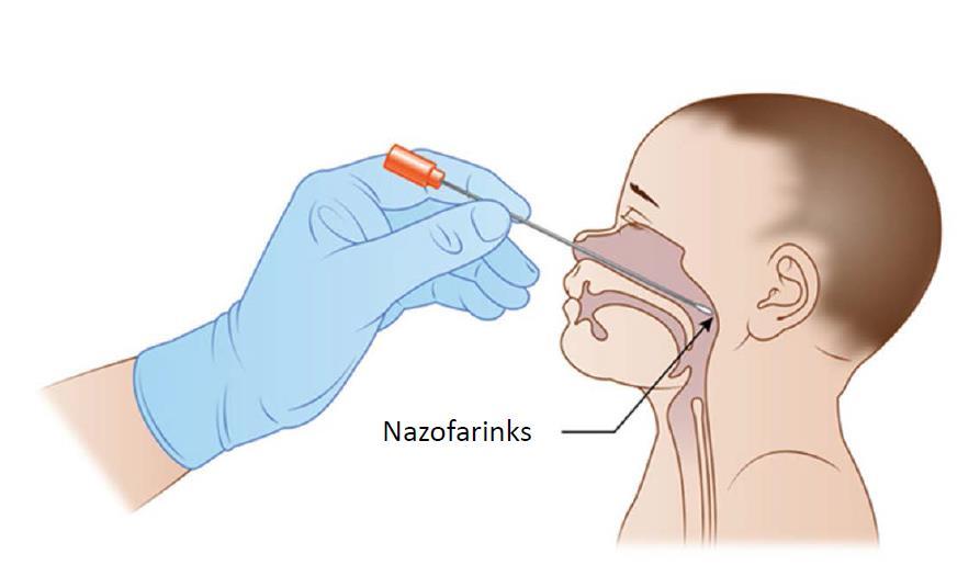 şişme (Quellung) reaksiyonu Pneumotest