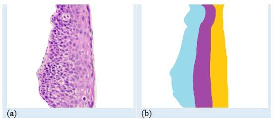 Hiperkromazi (H) Alt 1/3 Orta 1/3 Üst 1/3 H_O/ H_Ü/ H_Ü/ (A) (O) (Ü) H_A