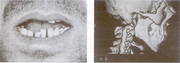 Resim 1. Resim 2. Resim 3. Resim 4. geçildi. Hemostazın salanmasının ardından temporal süperfasial fasiyanın dı tabakasına ula- ıldı.