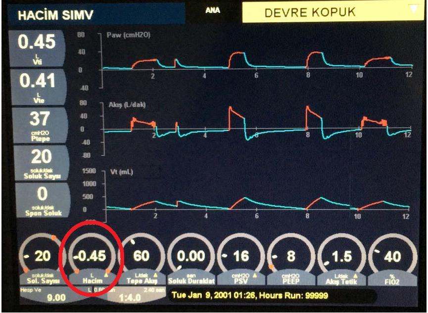 Mod ne olursa olsun amaç, PaCO2 düzeylerini hastanın bazal değerlerine yakın değerlere indirmeyi sağlayacak tidal