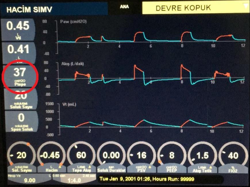 Ppeak (Ptepe) Hava yollarındaki basıncı gösterir. Eğer PEEP varsa bu da alveollere havanın sokulabilmesi için yenilmesi gereken ek bir yüktür.