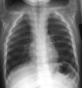 Tetkikler: PA Akciğer grafisi, deri prick testi, hemogram ve Total IgE istendi.