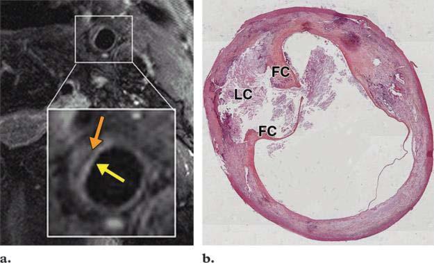 Karotid plak MR histopatolojik korelasyonu Semptomatik rüptüre plak Fibröz plak