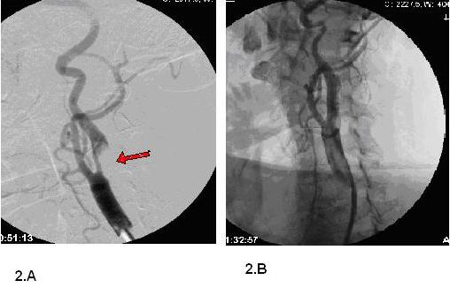 subjects. In the remaining 81 cases, a stenosis that requires an endovascular intervention was confirmed by angiography.