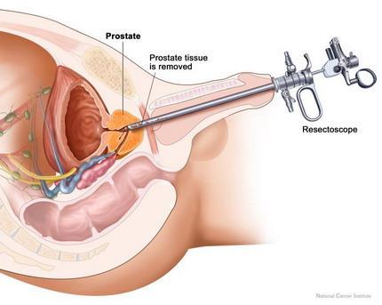 (TUIP) Lazer prostatektomi Hipertermi ve Termoterapi
