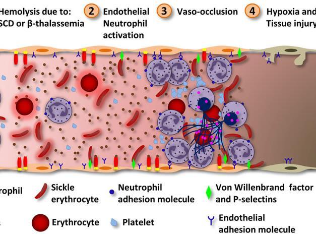 DTK patogenezinde İleri sürülen mekanizma 1. Orak eritrositler yada diğer inflamatuar belirteçler ile endotelin aktivasyonu 2. Adeziv nötrofillerin damar endotelinde birikmesi 3.