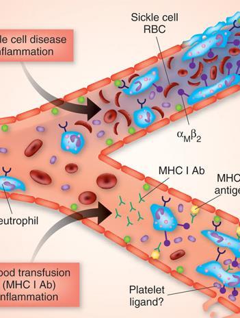 II. Anti-İnflamatuar etkisi olan tedaviler Orak eritrositlerin adezyonu: Orak eritrositlerin membran yapısında; hemoglobinin polimer formasyonunu alması ve mutasyona uğrayan globulinin